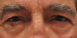 before and after surgery pictures | Top Miami Surgeon Gregory D. Lewen, MD