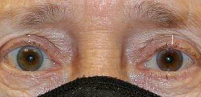 ptosis – 10