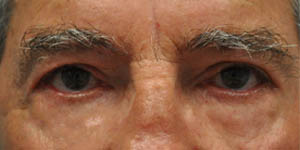 before and after surgery pictures | Top Miami Surgeon Gregory D. Lewen, MD