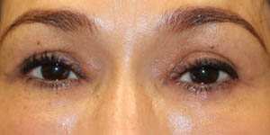 before and after surgery pictures | Top Miami Surgeon Gregory D. Lewen, MD