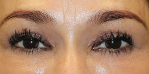 before and after surgery pictures | Top Miami Surgeon Gregory D. Lewen, MD