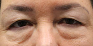 before and after surgery pictures | Top Miami Surgeon Gregory D. Lewen, MD