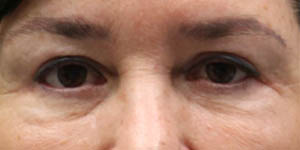 before and after surgery pictures | Top Miami Surgeon Gregory D. Lewen, MD