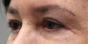 before and after surgery pictures | Top Miami Surgeon Gregory D. Lewen, MD