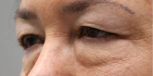 before and after surgery pictures | Top Miami Surgeon Gregory D. Lewen, MD