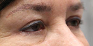 before and after surgery pictures | Top Miami Surgeon Gregory D. Lewen, MD