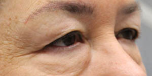 before and after surgery pictures | Top Miami Surgeon Gregory D. Lewen, MD