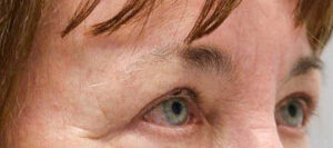 before and after surgery pictures | Top Miami Surgeon Gregory D. Lewen, MD