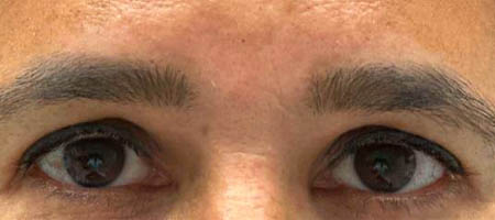 before and after surgery pictures | Top Miami Surgeon Gregory D. Lewen, MD