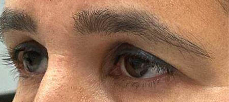 before and after surgery pictures | Top Miami Surgeon Gregory D. Lewen, MD