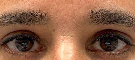 before and after surgery pictures | Top Miami Surgeon Gregory D. Lewen, MD