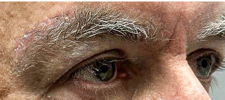 before and after surgery pictures | Top Miami Surgeon Gregory D. Lewen, MD