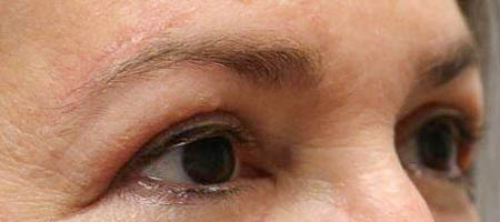 before and after surgery pictures | Top Miami Surgeon Gregory D. Lewen, MD