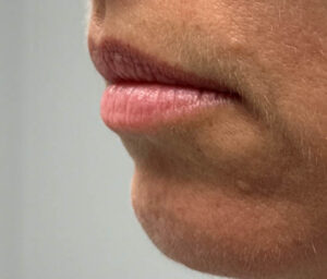 0000_patient-1-before-lip-filler-left-side.PNG-300×256