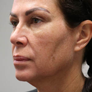 before and after surgery pictures | Top Miami Surgeon Gregory D. Lewen, MD