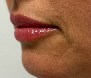 0001_patient-1-after-lip-filler-left-side.PNG-300×256