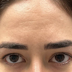 before and after surgery pictures | Top Miami Surgeon Gregory D. Lewen, MD