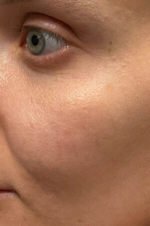 before and after surgery pictures | Top Miami Surgeon Gregory D. Lewen, MD