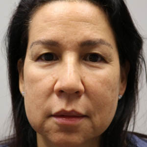 before and after surgery pictures | Top Miami Surgeon Gregory D. Lewen, MD