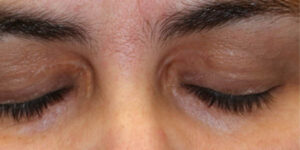 before and after surgery pictures | Top Miami Surgeon Gregory D. Lewen, MD