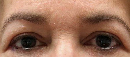 before and after surgery pictures | Top Miami Surgeon Gregory D. Lewen, MD