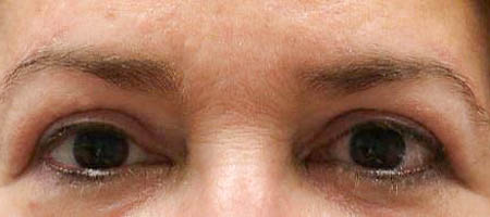 before and after surgery pictures | Top Miami Surgeon Gregory D. Lewen, MD
