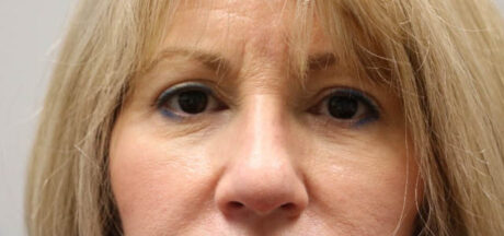 before and after surgery pictures | Top Miami Surgeon Gregory D. Lewen, MD