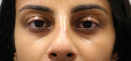 before and after surgery pictures | Top Miami Surgeon Gregory D. Lewen, MD