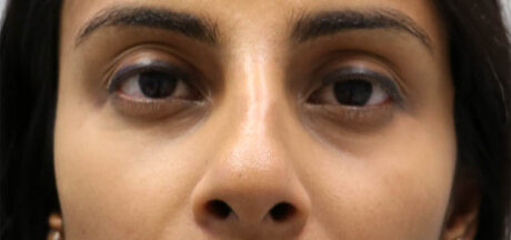 before and after surgery pictures | Top Miami Surgeon Gregory D. Lewen, MD