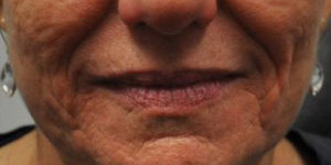 before and after surgery pictures | Top Miami Surgeon Gregory D. Lewen, MD