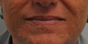 before and after surgery pictures | Top Miami Surgeon Gregory D. Lewen, MD