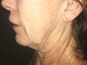 before and after surgery pictures | Top Miami Surgeon Gregory D. Lewen, MD
