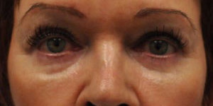 before and after surgery pictures | Top Miami Surgeon Gregory D. Lewen, MD
