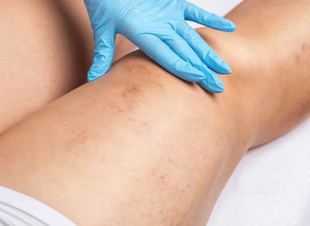 A close-up shot of a gloved hand examining a person's leg with visible veins. The hand is wearing a blue latex glove, carefully inspecting the skin during a medical procedure. - Spider Vein Treatment in Aventura, FL