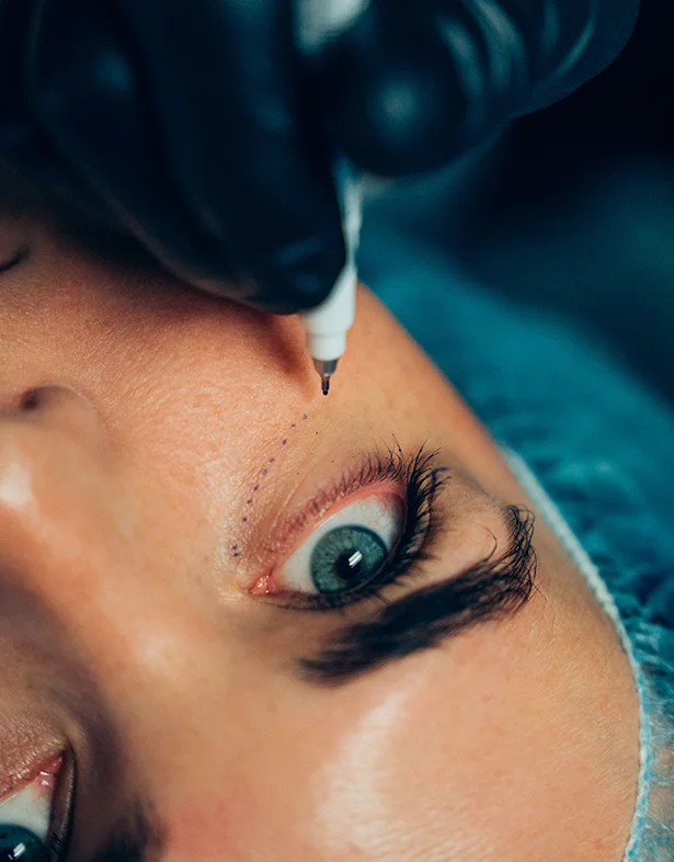 Eyelid surgery - Dr. Lewen drawing lower eyelid surgery lines