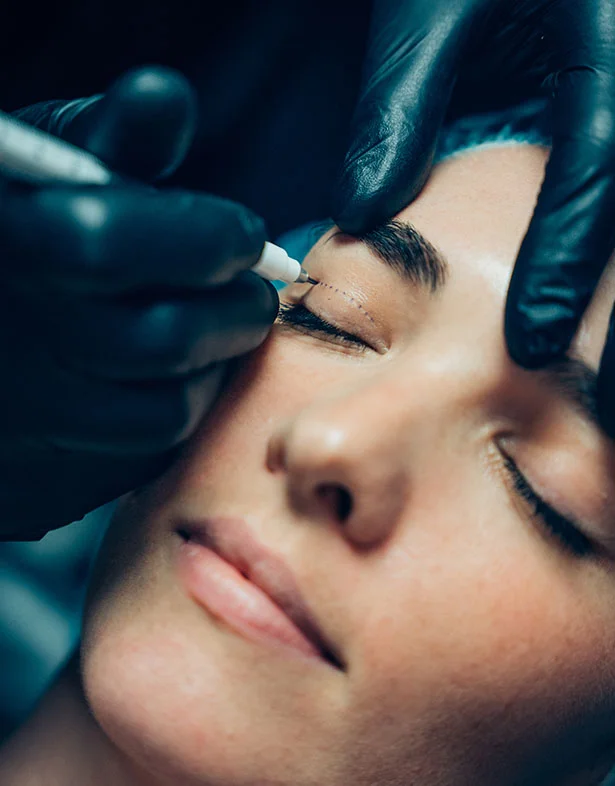 Upper Eyelid surgery - Dr. Lewen drawing eyelid surgery lines on patients eyelid