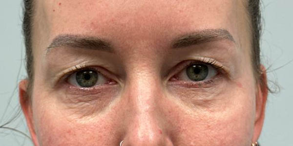 _0000_PT 45 before — EYES ONLY– upper and lower bleph with facial fat grafting, peri-orbital CO2 laser, temporal brow