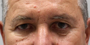 _0000_patient 1 before direct brow lift.PNG