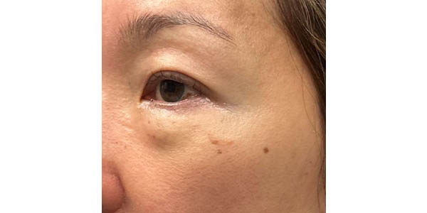 _0000_patient 102 before lower bleph with facial fat grafting.JPG