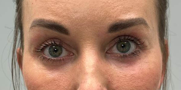 _0001_PT 45 after — EYES ONLY– upper and lower bleph with facial fat grafting, peri-orbital CO2 laser, temporal brow