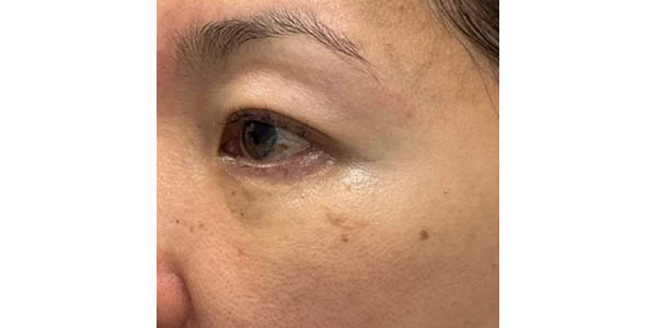_0001_patient 102 after lower bleph with facial fat grafting.JPG