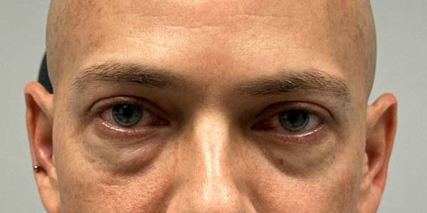 _0002_PT 44 before– eyes only.JPG