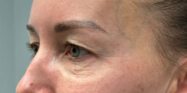 _0002_PT 45 before side– EYES ONLY– upper and lower bleph with facial fat grafting, peri-orbital CO2 laser, temporal