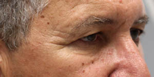 _0002_patient 1 before direct brow lift (side).PNG