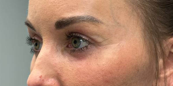 _0003_PT 45 after side– EYES ONLY– upper and lower bleph with facial fat grafting, peri-orbital CO2 laser, temporal b