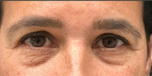 _0006_patient 3 before temporal brow lift (front)