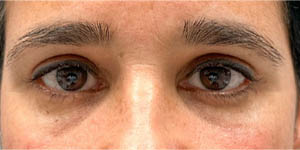 _0007_patient 3 after temporal brow lift (front).PNG