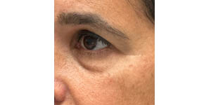 _0008_patient 3 before temporal brow lift (side).PNG