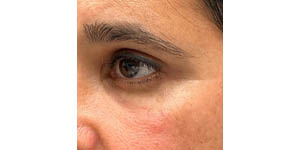 _0009_patient 3 after temporal brow lift (side).PNG