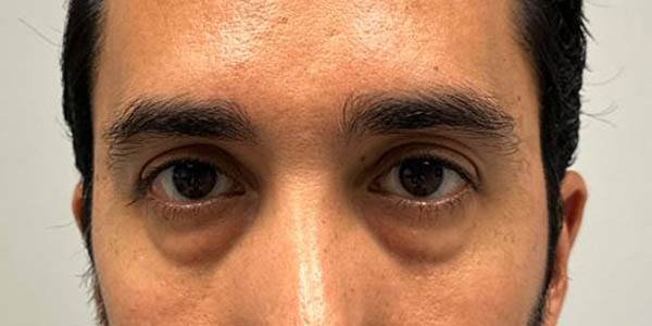 _0010_PT 46 before — eyes only.JPG